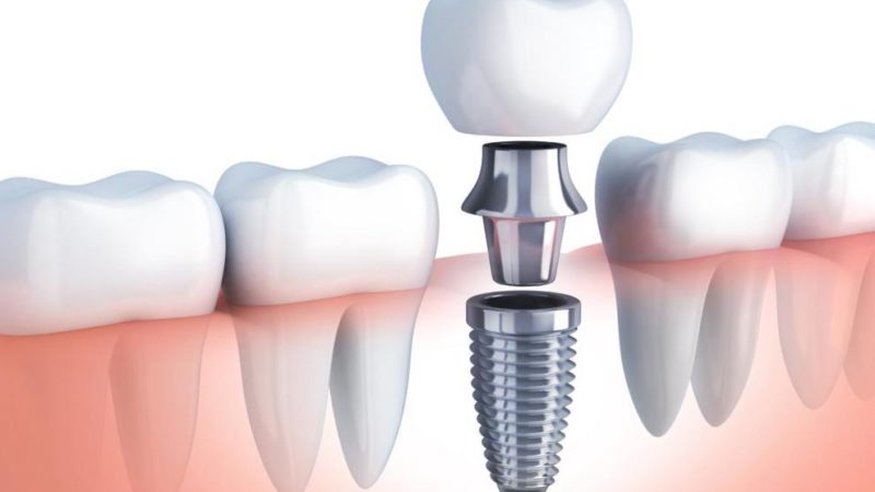 Implante-Dental
